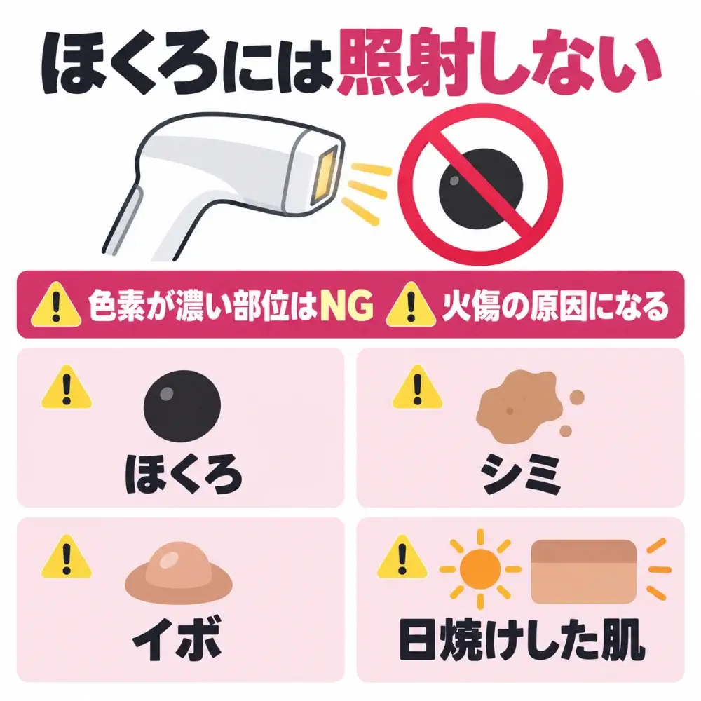 ケノンをほくろに照射できない理由。ほくろやシミなど色素が濃い部位は火傷の原因になるため照射しない。イボや日焼けした肌も同じように注意する